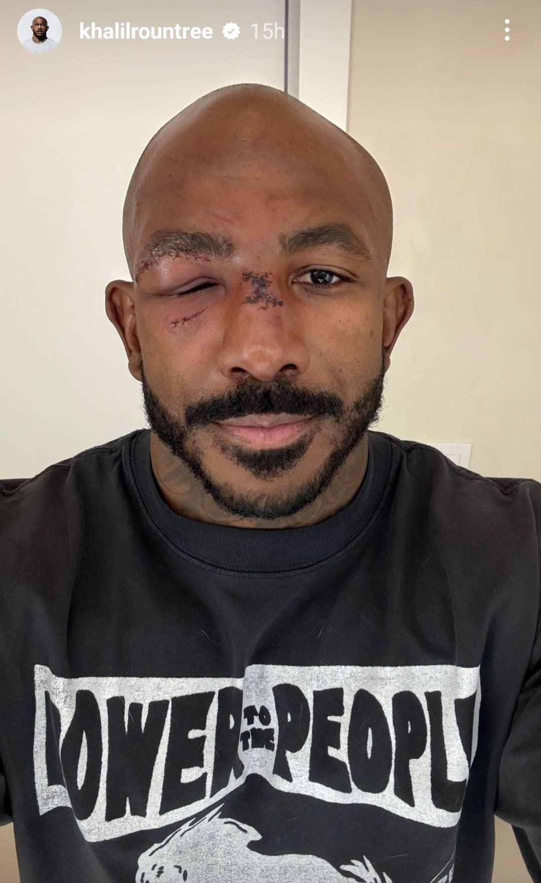 Rahnell Rountree Khalil Rountree Jr. shows off war scars following Alex Pereira defeat ...