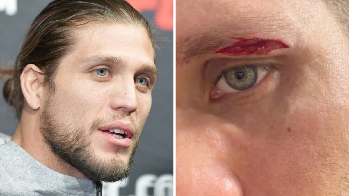 Brian Ortega shares graphic image of cut that forced him out of UFC 331