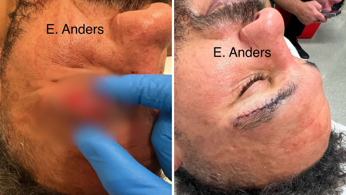Dana White posts graphic photo of injury caused by elbow KO