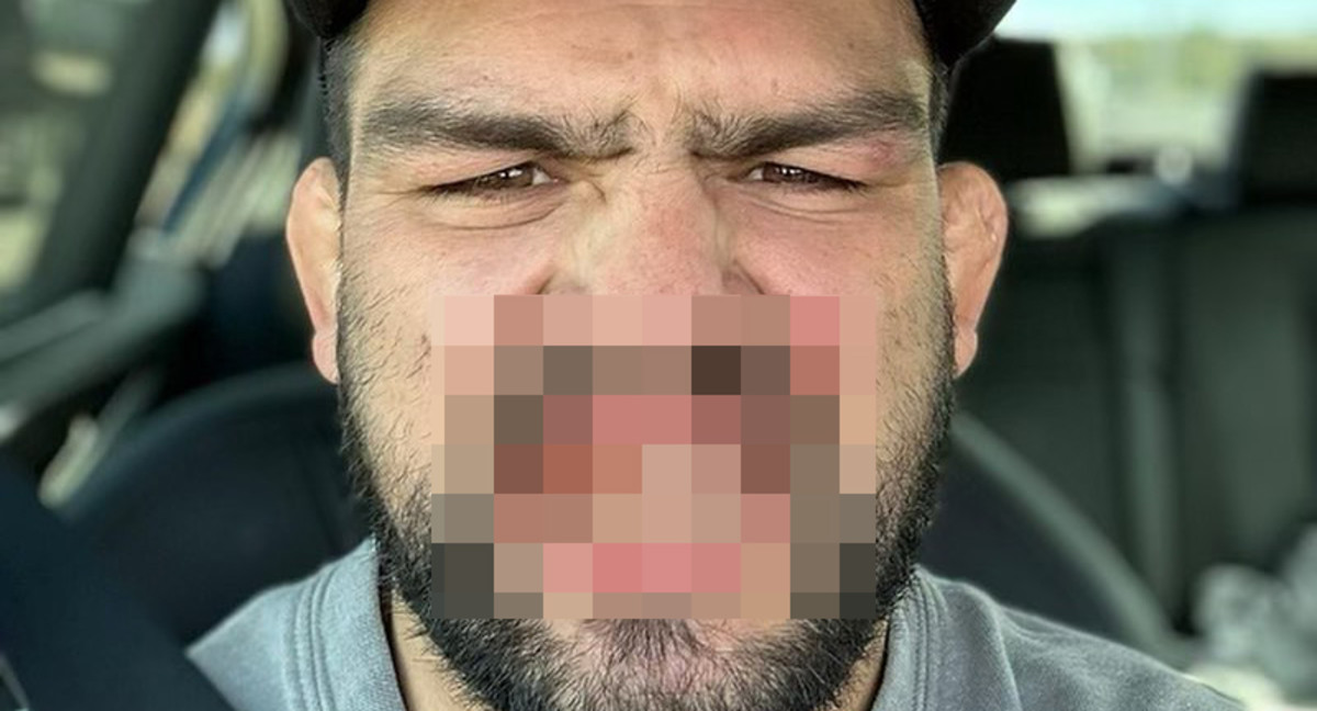 Kelvin Gastelum shares graphic video of mouth injury